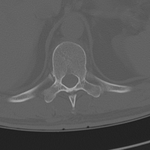 Chance fracture (Radiopaedia 33854-35020 Axial bone window 78).png