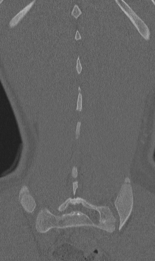 Chance fracture (Radiopaedia 40360-42912 Coronal bone window 61).png