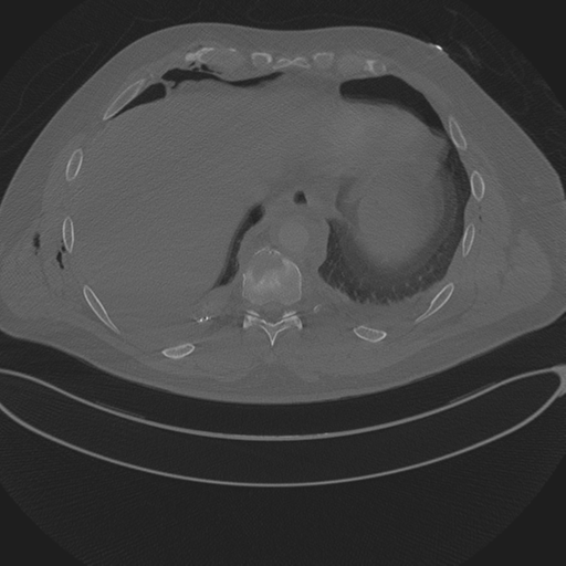 Chest multitrauma - aortic injury (Radiopaedia 34708-36147 Axial bone window 237).png