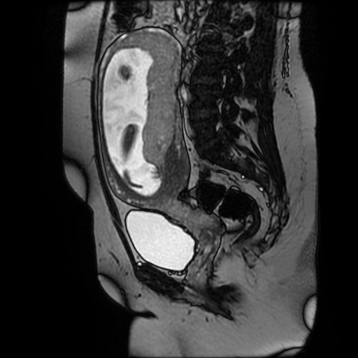 Chiari II malformation - fetal MRI (Radiopaedia 68099-77581 Sagittal Fiesta 33).jpg