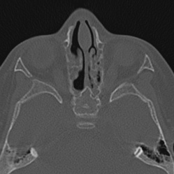 Choanal atresia (Radiopaedia 88525-105975 Axial bone window 61).jpg