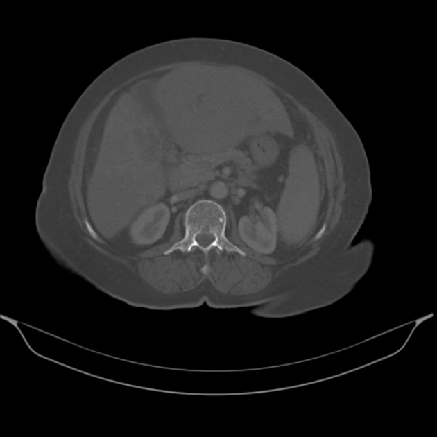 Cholangiocarcinoma (Radiopaedia 50592-56025 Axial bone window 31).jpg