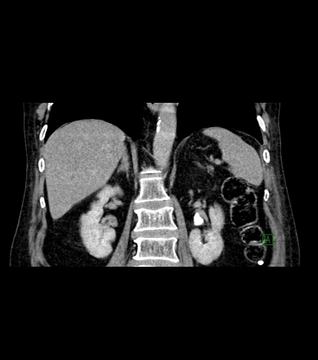 Cholangiocarcinoma with cerebral metastases (Radiopaedia 83519-98629 Coronal C+ delayed 52).jpg