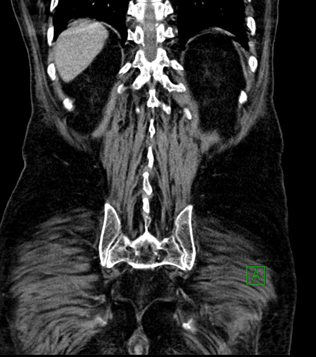 Cholangiocarcinoma with cerebral metastases (Radiopaedia 83519-98629 G 68).jpg