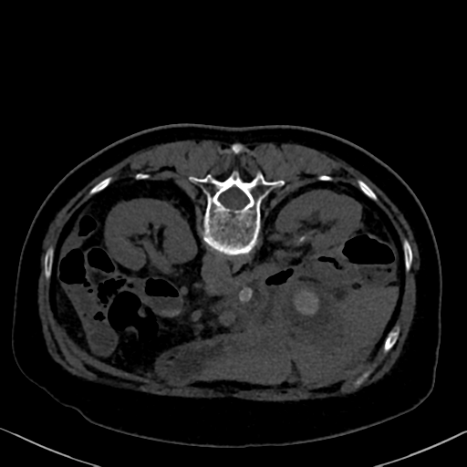File:Cholecystitis - obstructive choledocholitiasis (CT intravenous cholangiography) (Radiopaedia 43966-47479 Axial 16).png