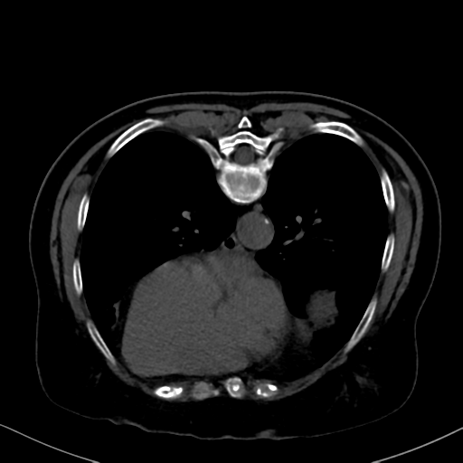 File:Cholecystitis - obstructive choledocholitiasis (CT intravenous cholangiography) (Radiopaedia 43966-47479 Axial 67).png