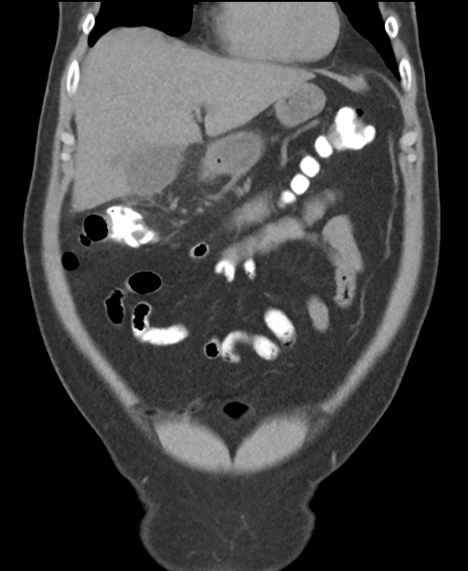 Cholecystitis with focal perforation and hepatic abscess (Radiopaedia 37189-38945 Coronal non-contrast 16).png
