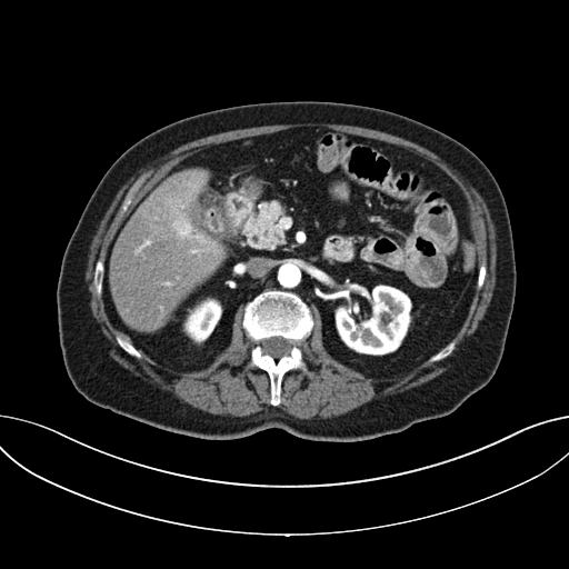 Cholecystoduodenal fistula due to calculous cholecystitis with gallstone migration (Radiopaedia 86875-103077 A 28).jpg