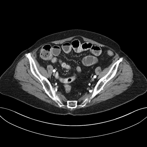 Cholecystoduodenal fistula due to calculous cholecystitis with gallstone migration (Radiopaedia 86875-103077 A 58).jpg