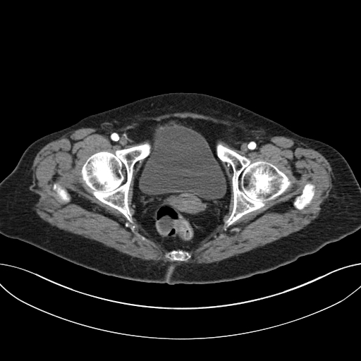 Cholecystoduodenal fistula due to calculous cholecystitis with gallstone migration (Radiopaedia 86875-103077 A 70).jpg
