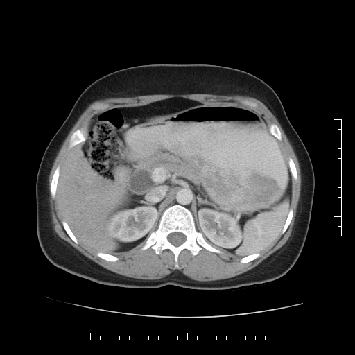 File:Choledochal cyst with chronic calcific pancreatitis (Radiopaedia 18245-18061 A 9).png