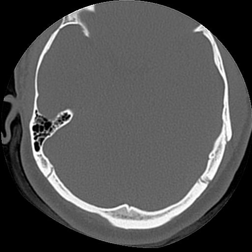 Cholesteatoma (Radiopaedia 84960-100474 Axial bone window 25).jpg