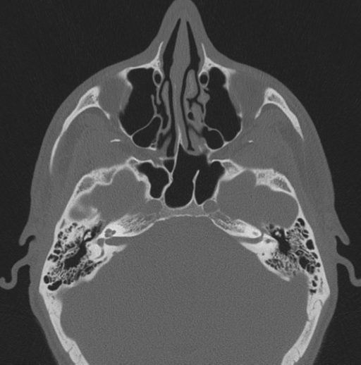 Chondrosarcoma (clivus) (Radiopaedia 46895-51425 Axial bone window 45).png