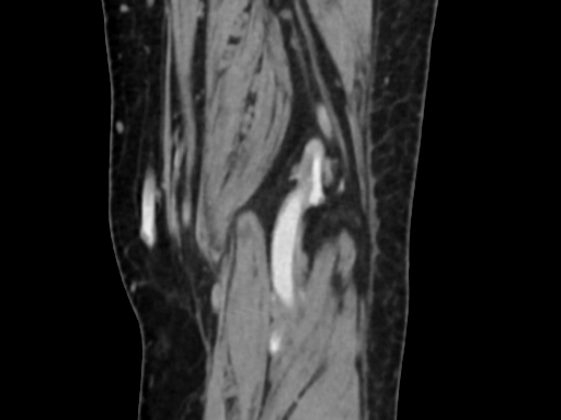 Chondrosarcoma - femur (Radiopaedia 64187-72954 C 53).jpg