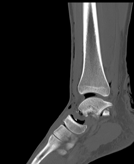 Chopart fracture (Radiopaedia 35347-36851 Sagittal bone window 32).jpg