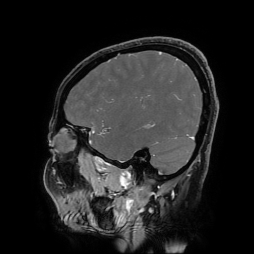 File:Chordoid glioma of third ventricle (Radiopaedia 91612-109340 F 155).jpg