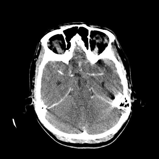 File:Choriocarcinoma of ovary with cerebral and pulmonary metastases (Radiopaedia 25983-26118 C+ arterial phase 50).jpg