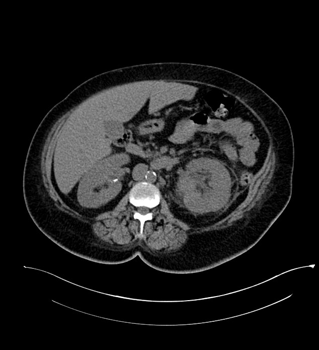 Chromophobe renal cell carcinoma (Radiopaedia 84239-99519 Axial non-contrast 75).jpg