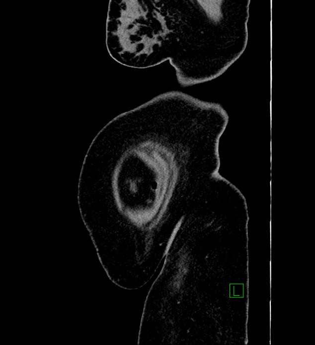 Chromophobe renal cell carcinoma (Radiopaedia 84239-99519 G 4).jpg