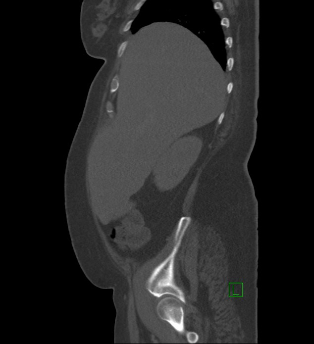 Chromophobe renal cell carcinoma (Radiopaedia 84239-99519 Sagittal bone window 86).jpg