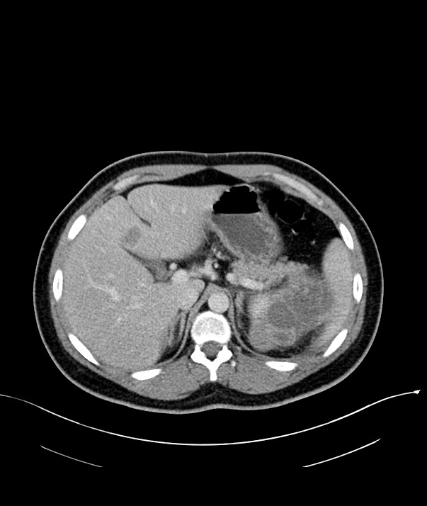 Chromophobe renal cell carcinoma (Radiopaedia 84255-99542 F 22).jpg