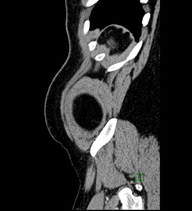 Chromophobe renal cell carcinoma (Radiopaedia 84286-99573 I 6).jpg