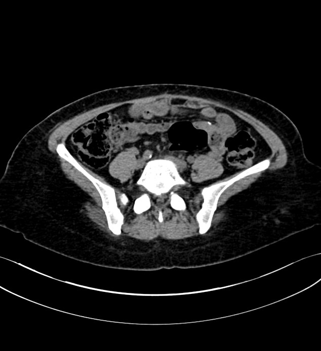 Chromophobe renal cell carcinoma (Radiopaedia 84290-99582 Axial non-contrast 101).jpg