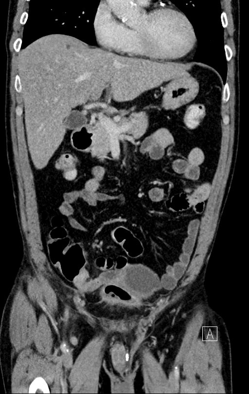 Chronic appendicitis complicated by appendicular abscess, pylephlebitis and liver abscess (Radiopaedia 54483-60700 C 29).jpg