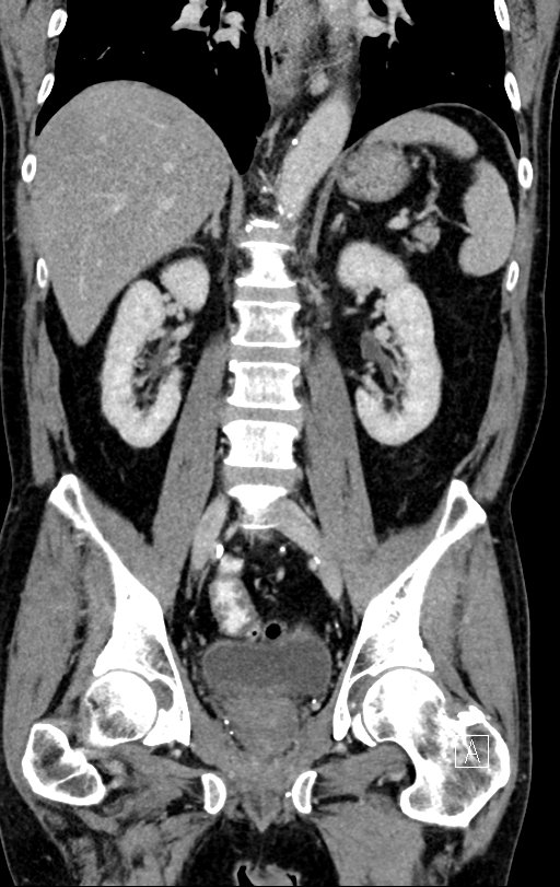 Chronic appendicitis complicated by appendicular abscess, pylephlebitis and liver abscess (Radiopaedia 54483-60700 C 50).jpg