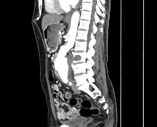 Chronic contained rupture of abdominal aortic aneurysm with extensive erosion of the vertebral bodies (Radiopaedia 55450-61901 B 37).jpg