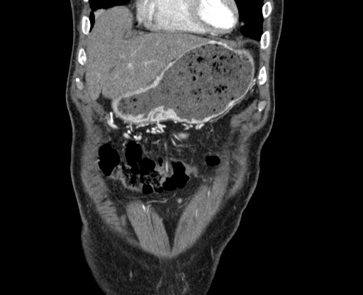 File:Chronic contained rupture of abdominal aortic aneurysm with extensive erosion of the vertebral bodies (Radiopaedia 55450-61901 D 2).jpg