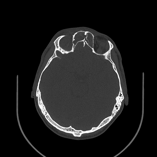 Chronic invasive fungal sinusitis (Radiopaedia 50342-55710 Axial bone window 103).jpg