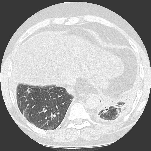Chronic lung allograft dysfunction - restrictive form (Radiopaedia 60595-68316 Axial lung window 56).jpg