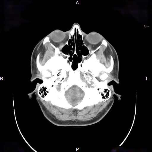 File:Chronic maxillary sinusitis with a foreign body (dental filling material) (Radiopaedia 7811-8639 Axial non-contrast 7).jpg