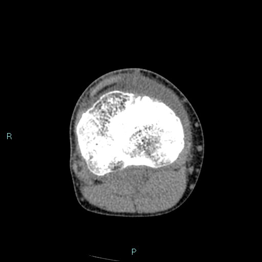 Chronic osteomyelitis (with Brodie abscess) (Radiopaedia 76405-88111 A 97).jpg
