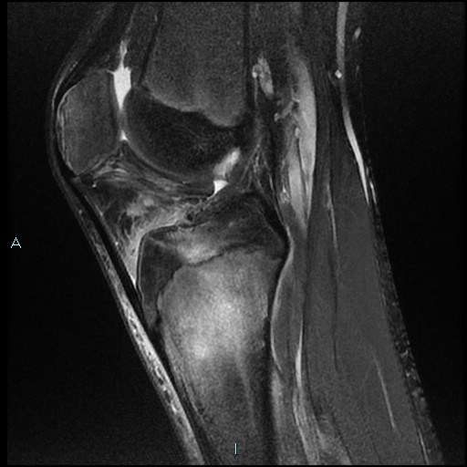 File:Chronic osteomyelitis (with Brodie abscess) (Radiopaedia 76405-88112 Sagittal PD fat sat 14).jpg