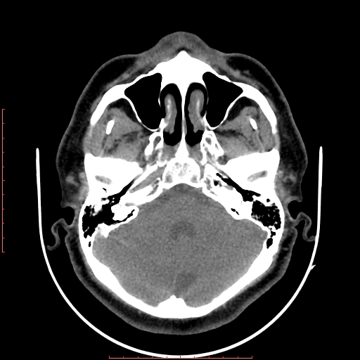 Chronic submandibular sialolithiasis (Radiopaedia 69817-79814 Axial non-contrast 5).jpg