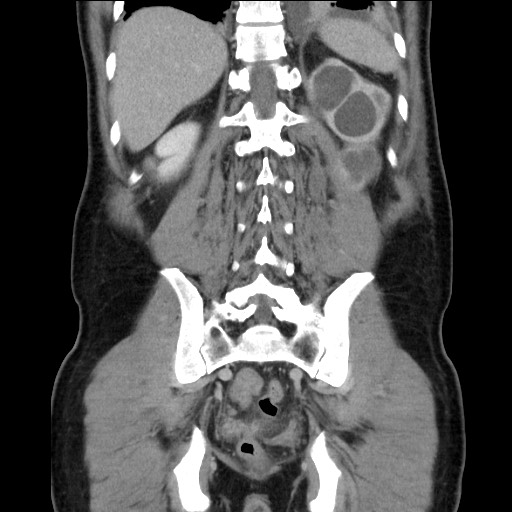 Chronic ureteropelvic junction obstruction (Radiopaedia 78365-90996 B 78).jpg