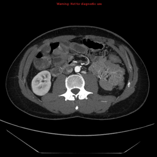 File:Circumaortic left renal vein (Radiopaedia 9069-9792 A 32).jpg