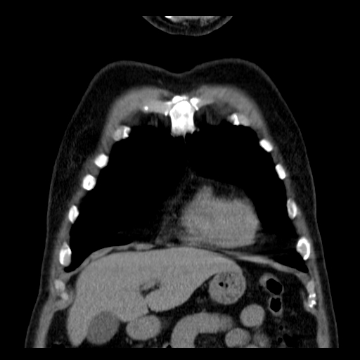 File:Classic complicated silicosis (Radiopaedia 49720-54961 Coronal liver window 8).jpg