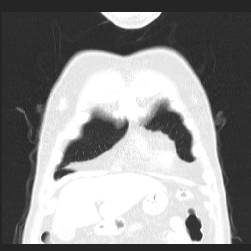 File:Classic complicated silicosis (Radiopaedia 49720-54961 Coronal lung window 4).jpg