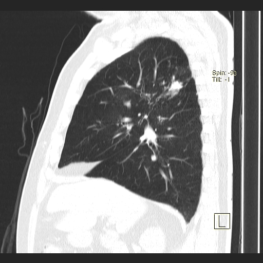 Classic complicated silicosis (Radiopaedia 49720-54961 Sagittal lung window 42).jpg