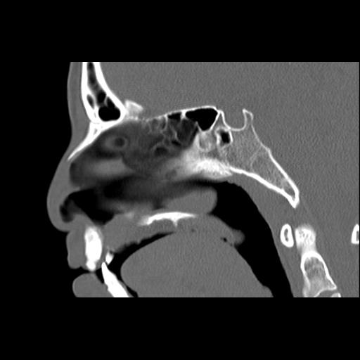 Cleft hard palate and alveolus (Radiopaedia 63180-71710 Sagittal bone window 25).jpg