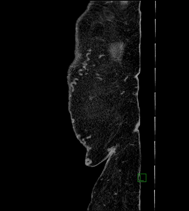 Closed-loop small bowel obstruction-internal hernia (Radiopaedia 78439-91096 C 10).jpg
