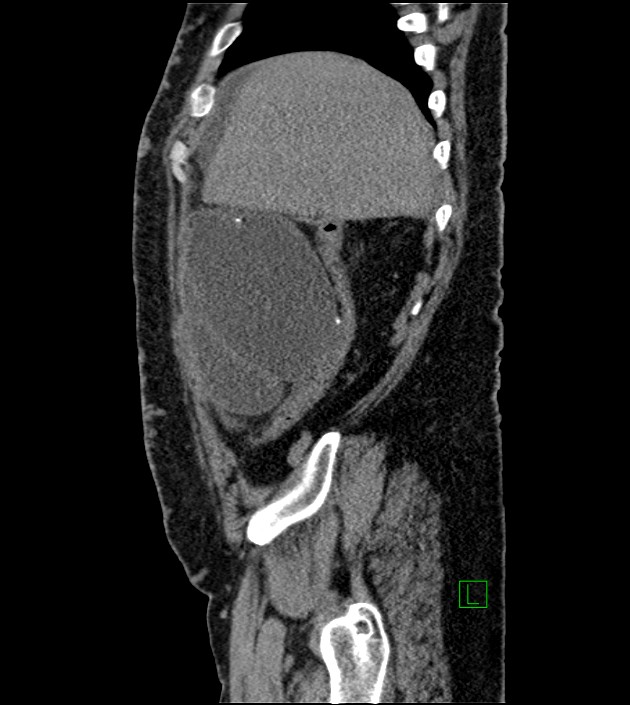 Closed-loop small bowel obstruction-internal hernia (Radiopaedia 78439-91096 C 117).jpg