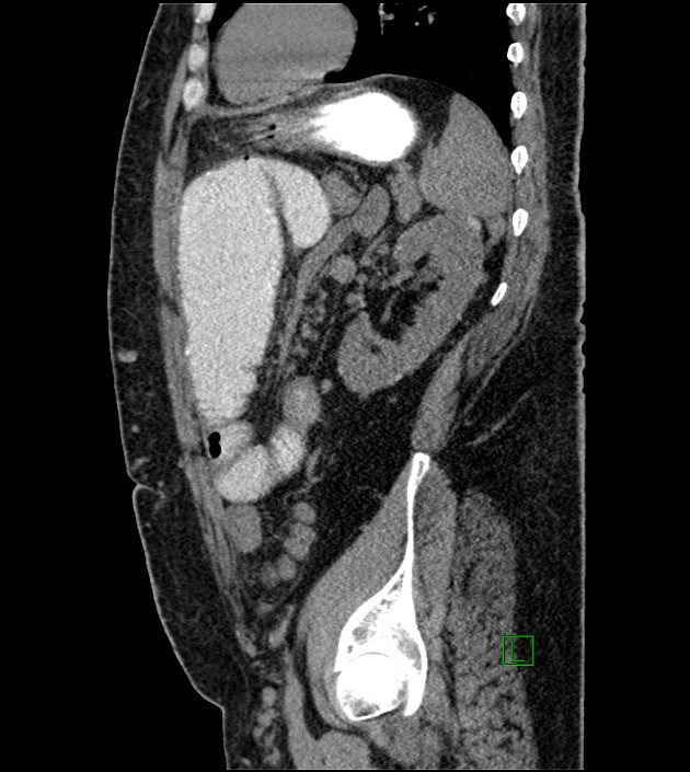 Closed-loop small bowel obstruction-internal hernia (Radiopaedia 78439-91096 C 49).jpg