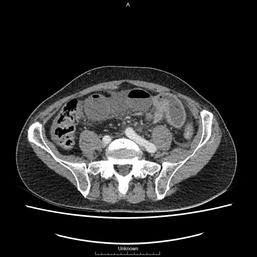 Closed loop bowel obstruction and ischemia (Radiopaedia 86959-103180 A 59).jpg