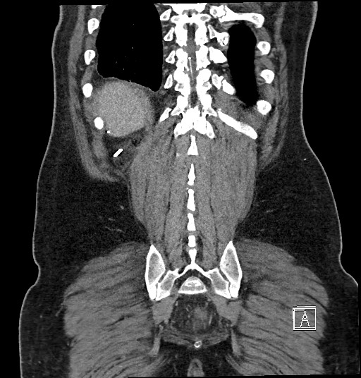 Closed loop obstruction - internal hernia into nephrectomy bed (Radiopaedia 59867-67320 B 122).jpg