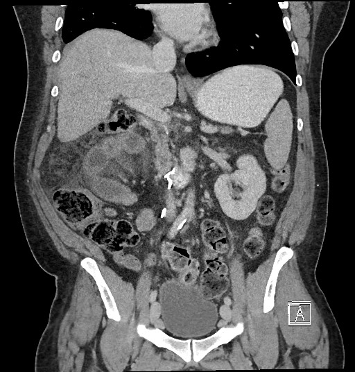 Closed loop obstruction - internal hernia into nephrectomy bed (Radiopaedia 59867-67320 B 68).jpg