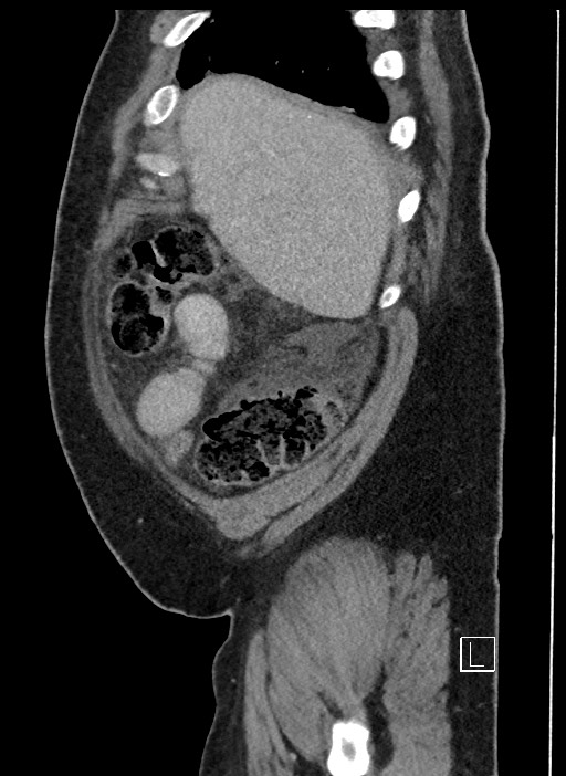 Closed loop obstruction - internal hernia into nephrectomy bed (Radiopaedia 59867-67320 C 96).jpg